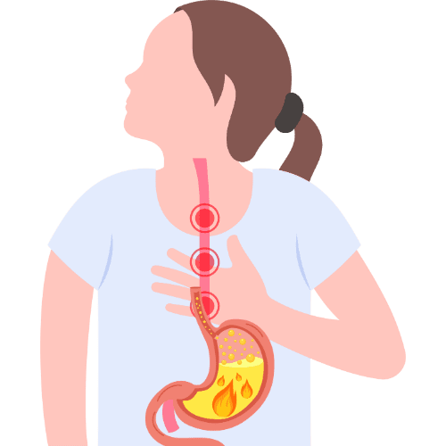 Illustration showing stomach acidity with burning sensation rising through the food pipe, representing acid reflux discomfort