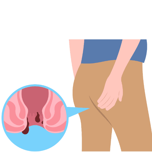 Illustration showing anal discomfort with visual representation of irritation and pain affecting daily comfort.